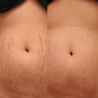 Stretch Marks and Scars Removal Cream for Pregnancy