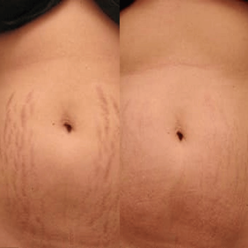 Stretch Marks and Scars Removal Cream for Pregnancy