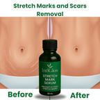 Stretch Marks and Scars Removal Cream for Pregnancy