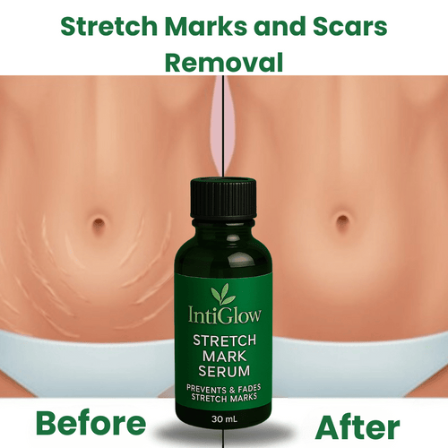 Stretch Marks and Scars Removal Cream for Pregnancy