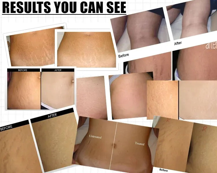 Stretch Marks and Scars Removal Cream for Pregnancy